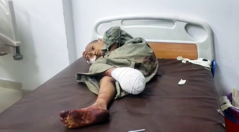 niño de Yemen víctima del terrorismo saudita